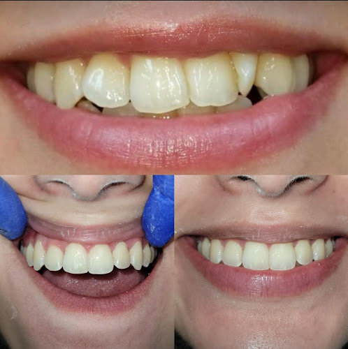 Dentistry On Park – Dr Daniil Payziyev: Best Cosmetic Dentist Upper East Side, Dental Implants