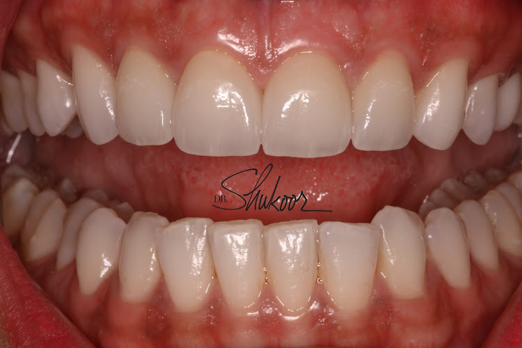 DC Same Day Dental Crowns