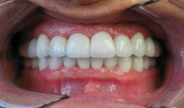 A-Implant Dental Laboratory